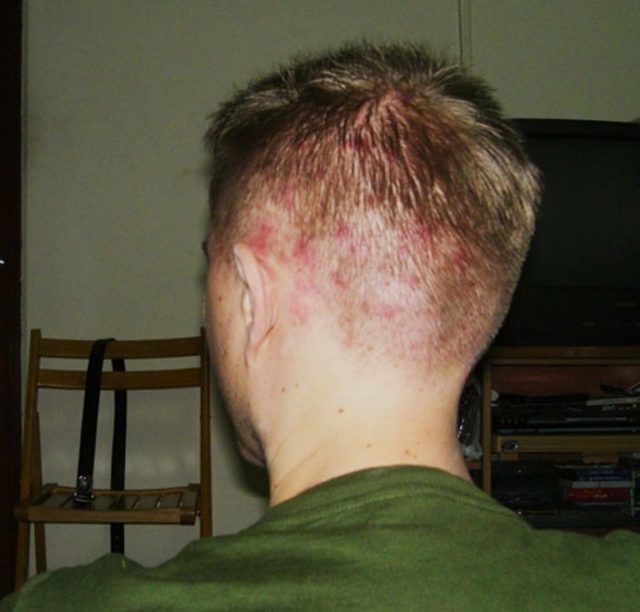 Cause di acne sulla testa negli uomini