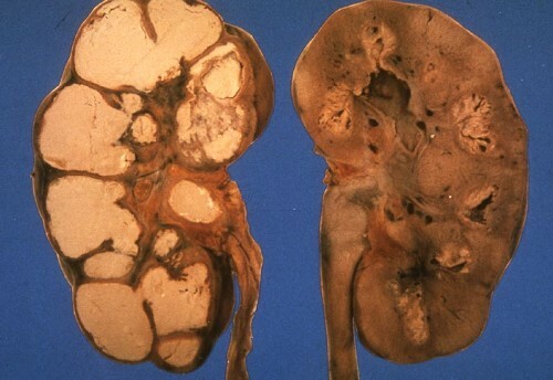 Signs and treatment of kidney tuberculosis