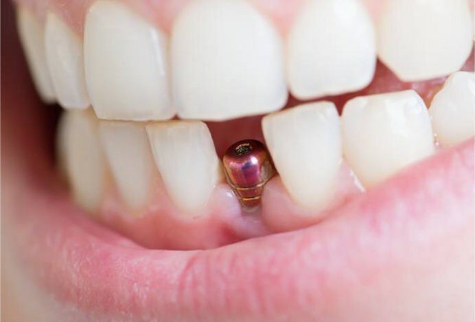 Zubná implantácia v Moskve na zubnej klinike - kam ísť
