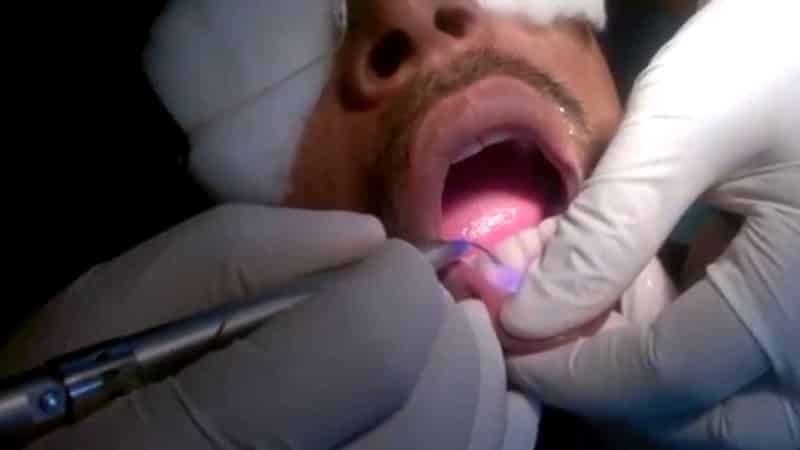 Fistula auf dem Zahnfleisch des Kindes: Foto, Behandlung, was zu tun ist