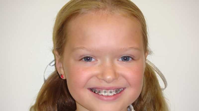 Schiefe Zähne: Fotos von Kindern vor und nach der Korrektur