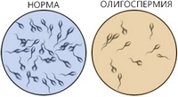 Oligospermia in micropen