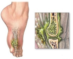 Causes of osteomyelitis