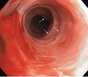Catarrale oesofagitis: oorzaken, symptomen, diagnose en behandeling