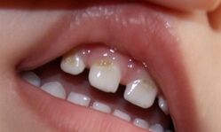Caries of milk teeth