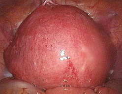 Myom des Uterus