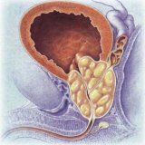 Historie případu: adenom prostaty