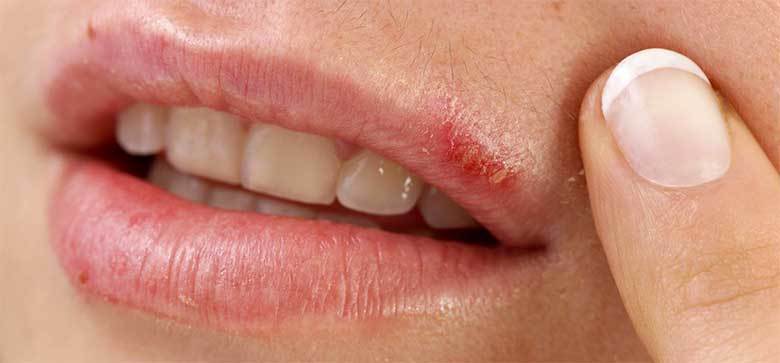 Pogotovo pojava herpesa na usnama ljudi