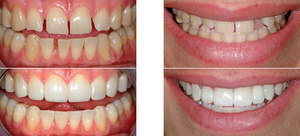 Restaurering av tenner er svært nødvendig i mange tilfeller.