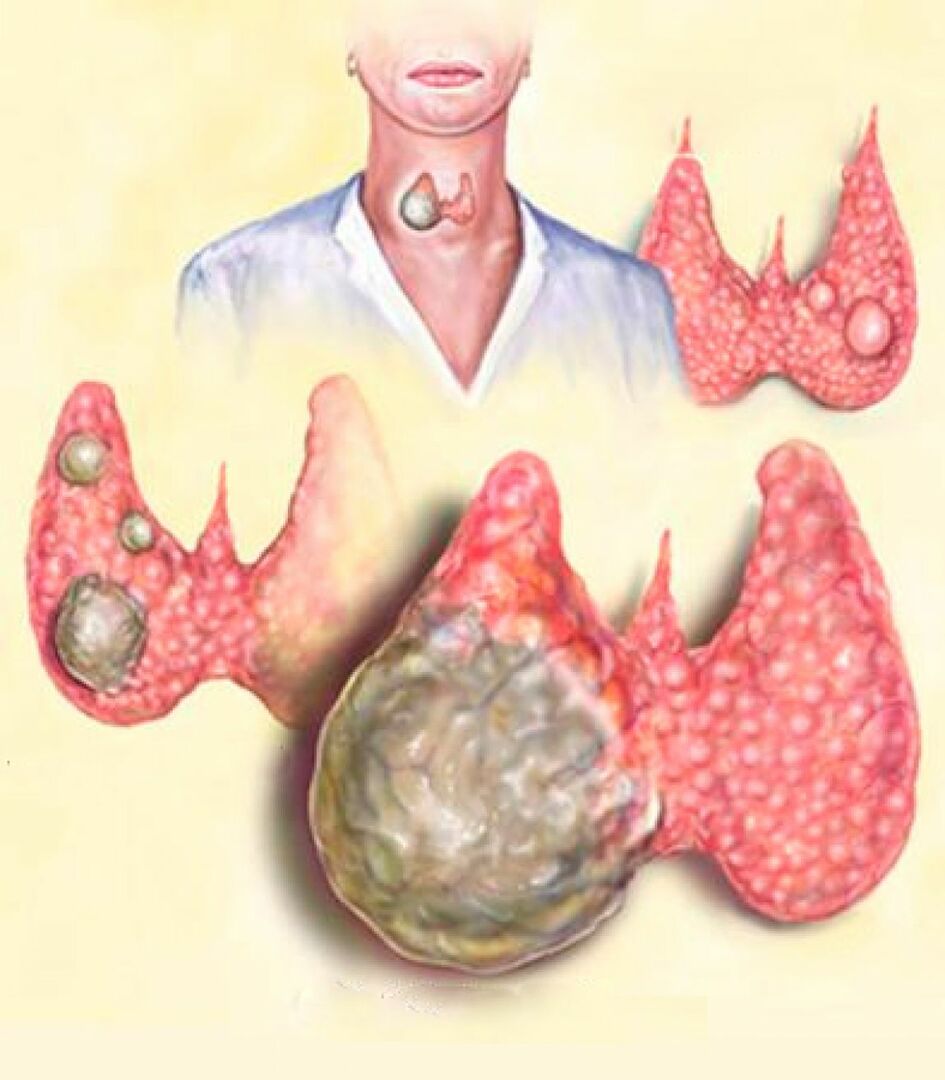 Varieties of the thyroid cyst