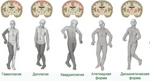 Hemiplegische Form der Zerebralparese