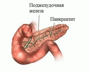 Pancreatitis ziekte