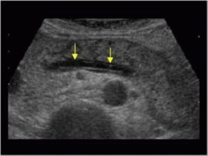 Pancreaschirurgie voor pancreatitis: acute fase chirurgie