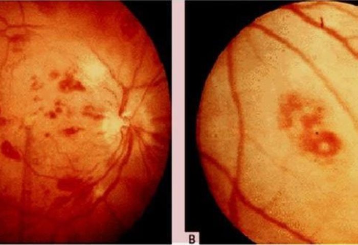 Roth spots