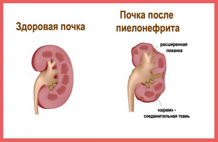 Pyelonephritis in women in different age