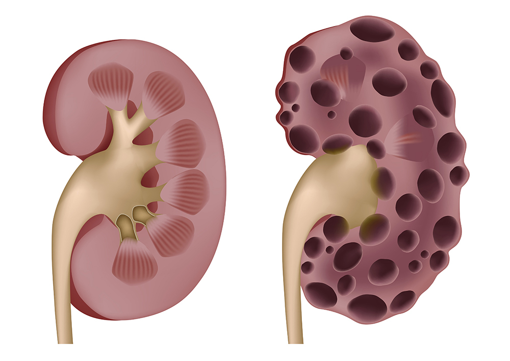 Polycystic kidney: symptoms, treatment and diet