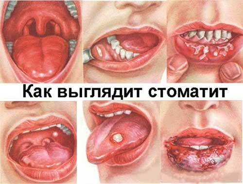genezen zweren in de mond voor kinderen volwassenen kinderen