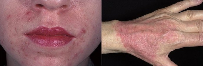 krónikus allergiás dermatitis