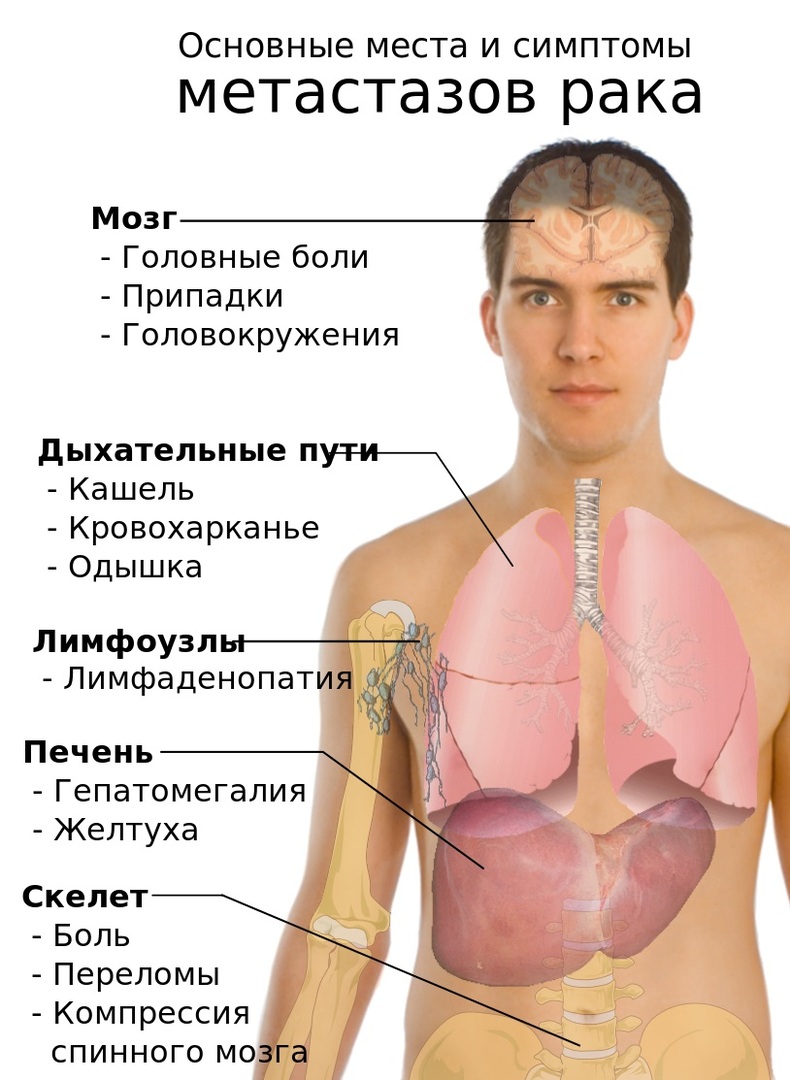 Rak pluća: simptomi, dijagnoza, liječenje i prevenciju prognoze