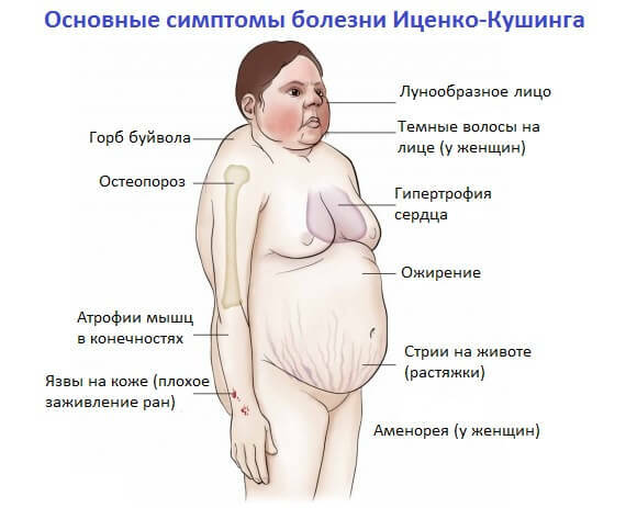 simptomy_bolezni_Icenko_Kushinga