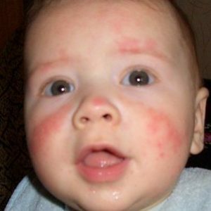 Лечење-алергија-И-грудног - 640к302 деца