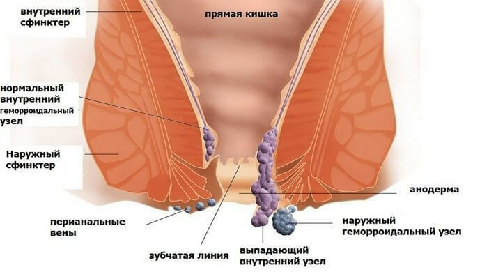 пролапс хемороиди