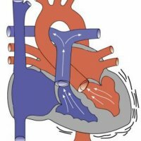 Pulmonale arterie stenose