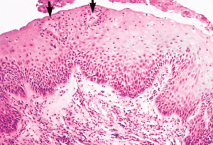 Pathologie van reflux-oesofagitis