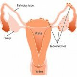 Modern methods of treatment of endometriosis