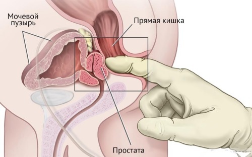 How to recognize the first symptoms of colorectal cancer?