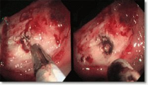 Endoscopie voor chirurgische therapie