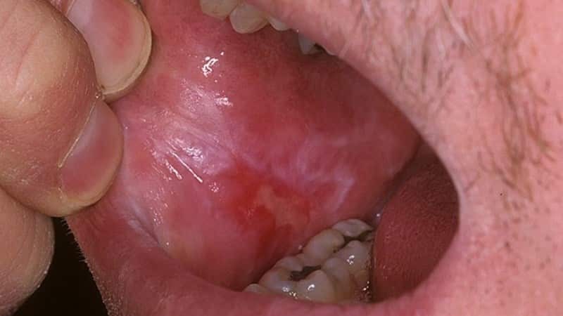 Red flat-leafed diarrhea in the mouth Photo