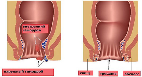 Operation with hemorrhoids