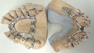 spjelking protese