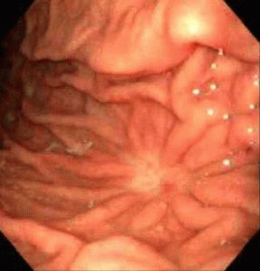 Degeneratie tot een kwaadaardige tumor