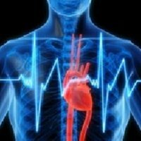 Acute myocardial infarction