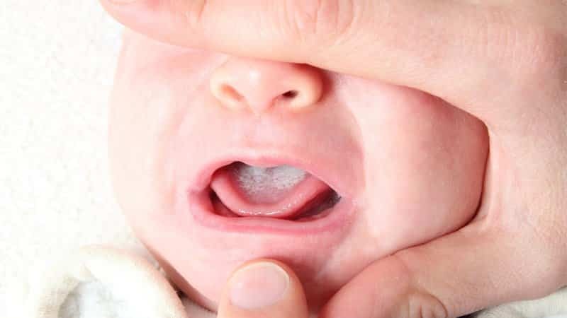 biele škvrny na perách liečby dieťaťa