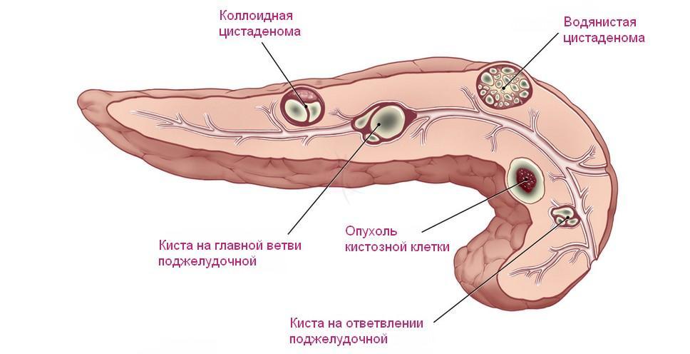 Cysta pankreasu a jej typy