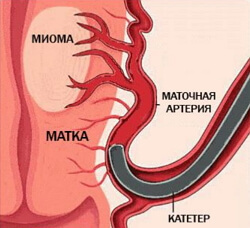 Embolization of uterine arteries