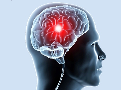 Oštećenje krvnih žila mozga