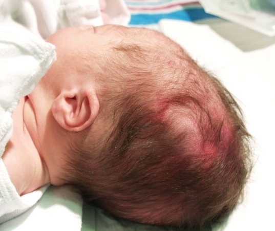 Hämatome auf dem Kopf bei Neugeborenen