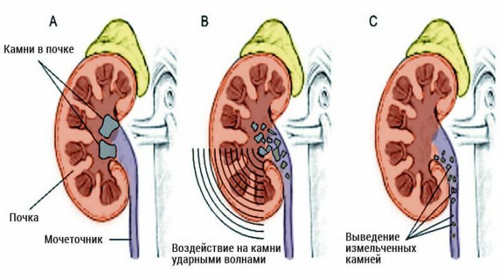 Types of lithotripsy, their advantages and disadvantages