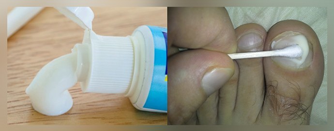Aplicação de pasta de dente na lesão