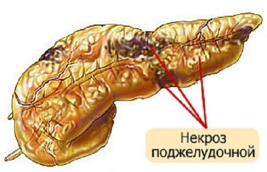 Obrázok pankreatickej nekrózy pankreasu