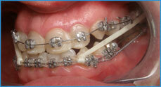 Retinirani zub