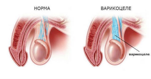 pathologie van het scrotum