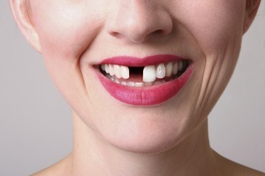 Korlátozások a fogászati ​​implantátumok: a fő ellenjavallat eljárás, fogászati ​​ajánlások