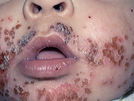 Virale Pemphigus bei Kindern - die wichtigsten Symptome, Foto