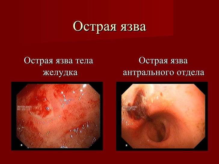 Acute-ulcus