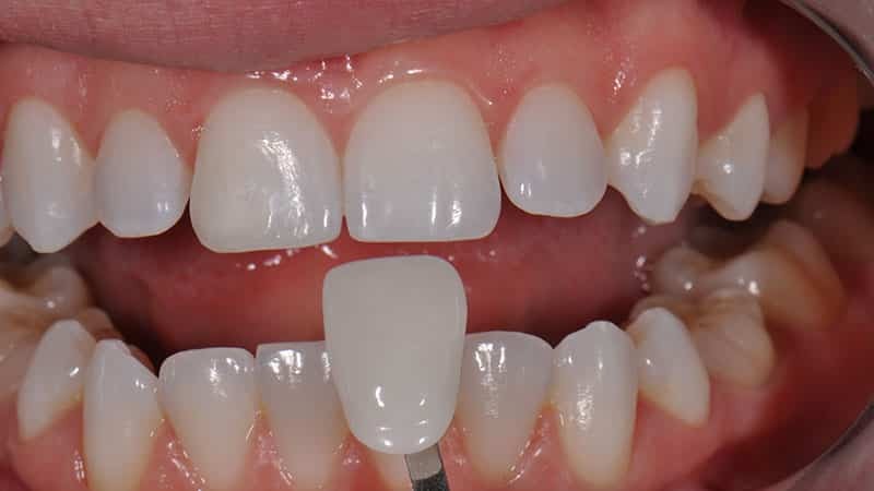 Fikse skallfasetter på tennene bilde